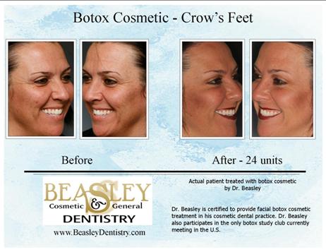 A before/after picture of crows feet treated by Huntsville Botox.