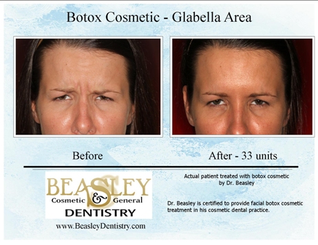 Botox before/after