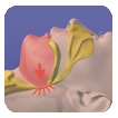 An illustration of a throat passage suffering from obstructive sleep apnea.